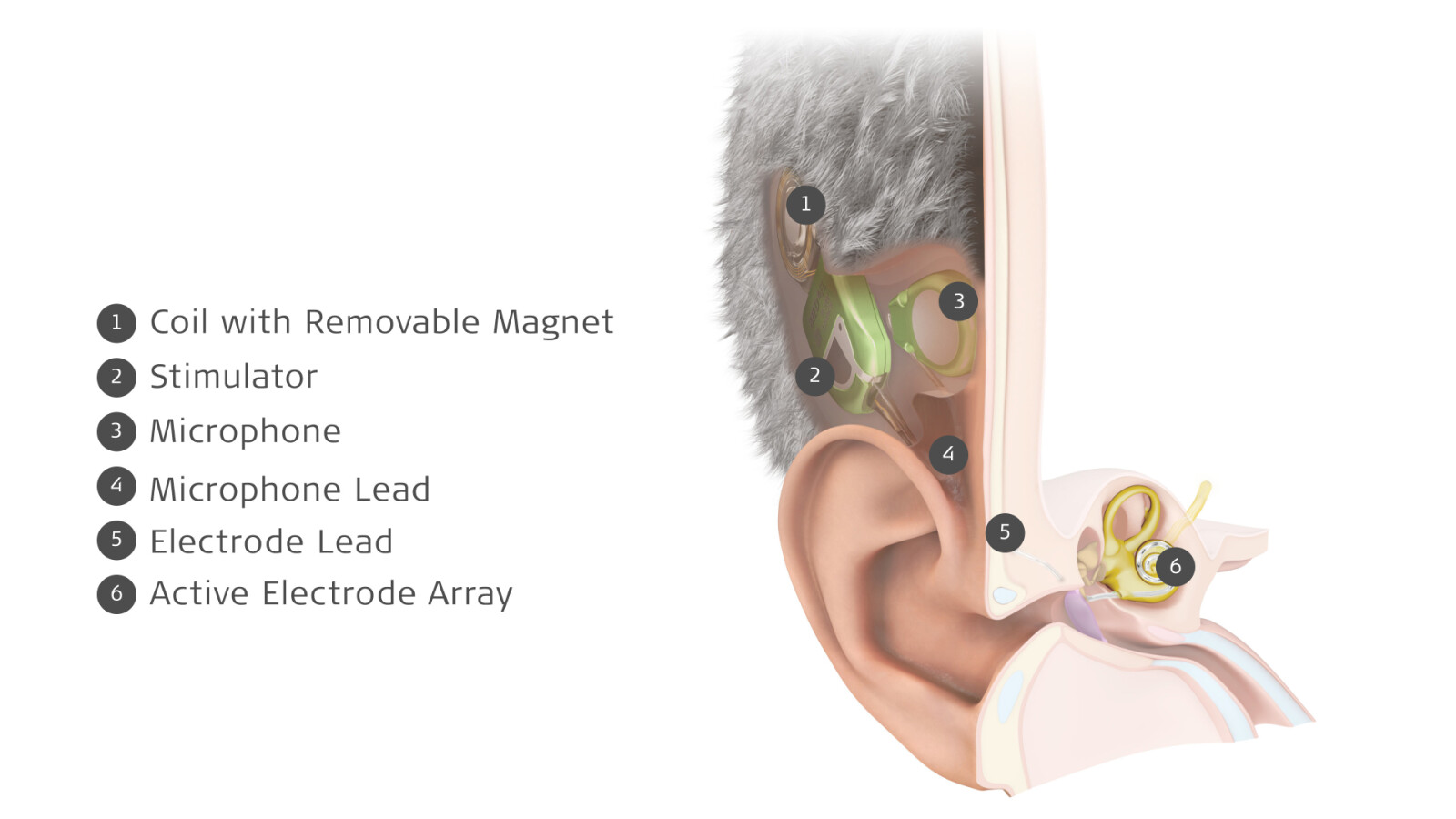 MED-EL Launches World's First Commercially Available Totally Invisible Cochlear Implant Copyright: MED-EL